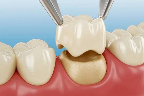 Zirconia Crown